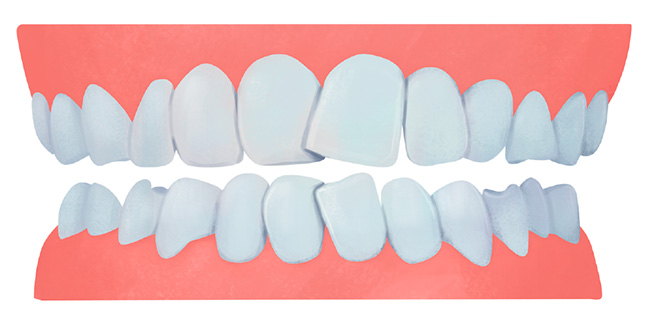 Encombrement ou chevauchement dentaire